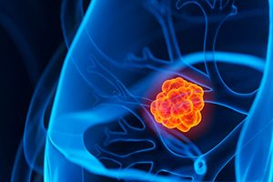 FDA приостановило исследования препарата Iovance для лечения рака легкого