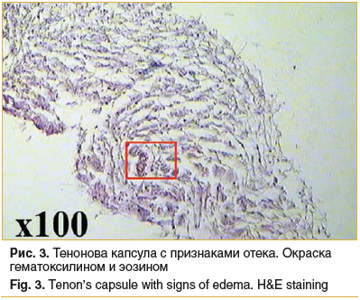 Рис. 3. Тенонова капсула с признаками отека. Окраска гематоксилином и эозином Fig. 3. Tenon’s capsule with signs of edema. H&E staining