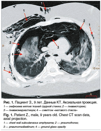 Рис. 1. Пациент З., 9 лет. Данные КТ. Аксиальная проекция. 1 — эмфизема мягких тканей грудной стенки; 2 — пневмоторакс; 3 — пневмомедиастинум; 4 — симптом «матового стекла» Fig. 1. Patient Z., male, 9 years old. Chest CT scan data, axial projection. 1 — c
