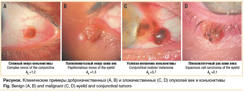 Рисунок. Клинические примеры доброкачественных (A, B) и злокачественных (C, D) опухолей век и конъюнктивы Fig. Benign (A, B) and malignant (C, D) eyelid and conjunctival tumors