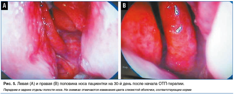 Рис. 5. Левая (А) и правая (В) половина носа пациентки на 30-й день после начала ОТП-терапии. Передние и задние отделы полости носа. На снимках отмечаются изменения цвета слизистой оболочки, соответствующие норме