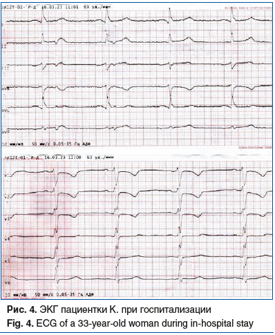 Рис. 4. ЭКГ пациентки К. при госпитализации Fig. 4. ECG of a 33-year-old woman during in-hospital stay