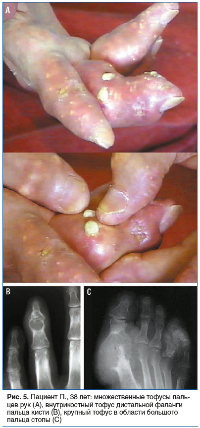 Рис. 5. Пациент П., 38 лет: множественные тофусы паль- цев рук (А), внутрикостный тофус дистальной фаланги пальца кисти (B), крупный тофус в области большого пальца стопы (C)