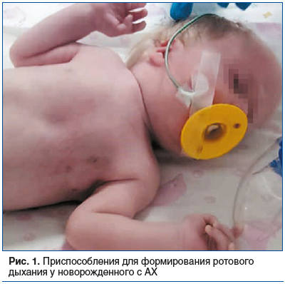 Рис. 1. Приспособления для формирования ротового дыхания у новорожденного с АХ