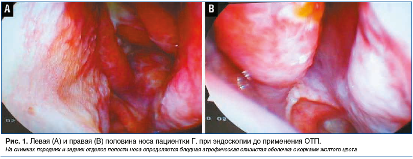 Рис. 1. Левая (А) и правая (В) половина носа пациентки Г. при эндоскопии до применения ОТП. На снимках передних и задних отделов полости носа определяется бледная атрофическая слизистая оболочка с корками желтого цвета