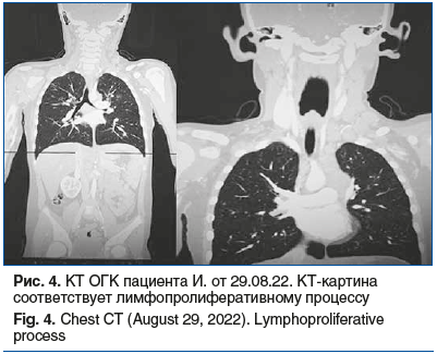 Рис. 4. КТ ОГК пациента И. от 29.08.22. КТ-картина соответствует лимфопролиферативному процессу Fig. 4. Chest CT (August 29, 2022). Lymphoproliferative process
