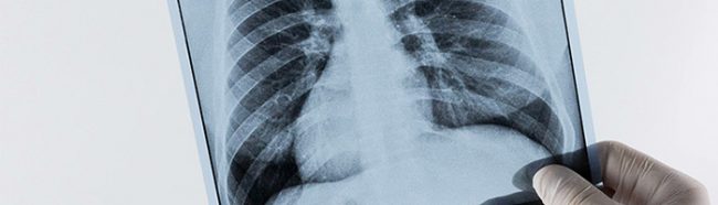 Выдача разрешения на применение Дупиксента для лечения ХОБЛ откладывается