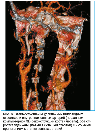 Рис. 6. Взаимоотношение удлиненных шиловидных отростков и внутренних сонных артерий (по данным компьютерной 3D-реконструкции костей черепа): оба от- ростка удлинены (левый в большей степени) с интимным прилеганием к стенке сонных артерий
