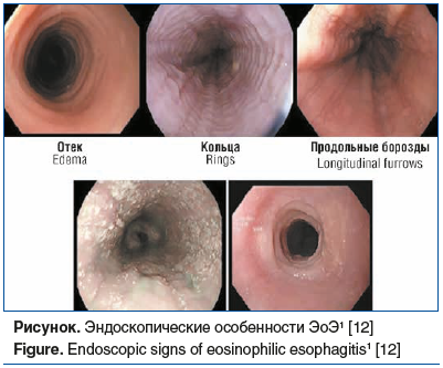 Рисунок. Эндоскопические особенности ЭоЭ1 [12] Figure. Endoscopic signs of eosinophilic esophagitis1 [12]