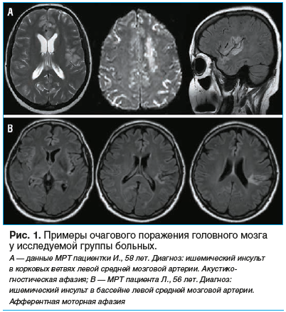 Рис. 1. Примеры очагового поражения головного мозга у исследуемой группы больных.