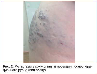 Рис. 2. Метастазы в кожу спины в проекции послеоперационного рубца (вид сбоку)