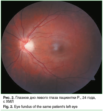 Рис. 2. Глазное дно левого глаза пациентки Р., 24 года, с ХМЛ Fig. 2. Eye fundus of the same patient's left eye