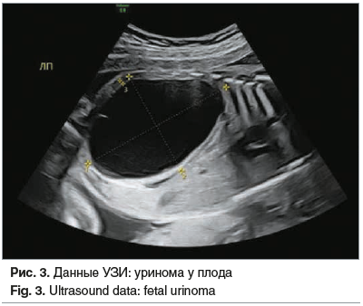 Рис. 3. Данные УЗИ: уринома у плода Fig. 3. Ultrasound data: fetal urinoma