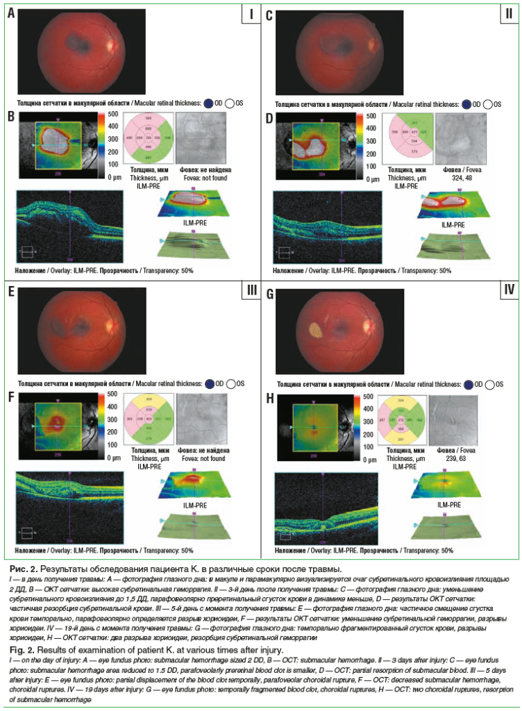 Рис. 2. Результаты обследования пациента K. в различные сроки после травмы. I — в день получения травмы: A — фотография глазного дна: в макуле и парамакулярно визуализируется очаг субретинального кровоизлияния площадью 2 ДД, B — ОКТ сетчатки: высокая субр