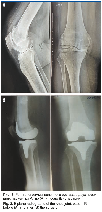 Рис. 3. Рентгенограммы коленного сустава в двух проек- циях пациентки Р. до (A) и после (B) операции Fig. 3. Biplane radiographs of the knee joint, patient R., before (A) and after (B) the surgery