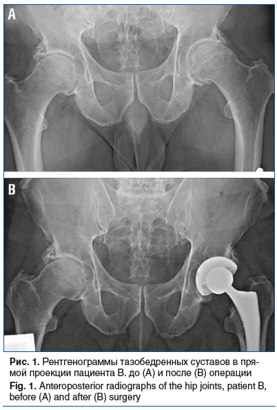 Рис. 1. Рентгенограммы тазобедренных суставов в пря- мой проекции пациента В. до (A) и после (B) операции Fig. 1. Anteroposterior radiographs of the hip joints, patient B, before (A) and after (B) surgery