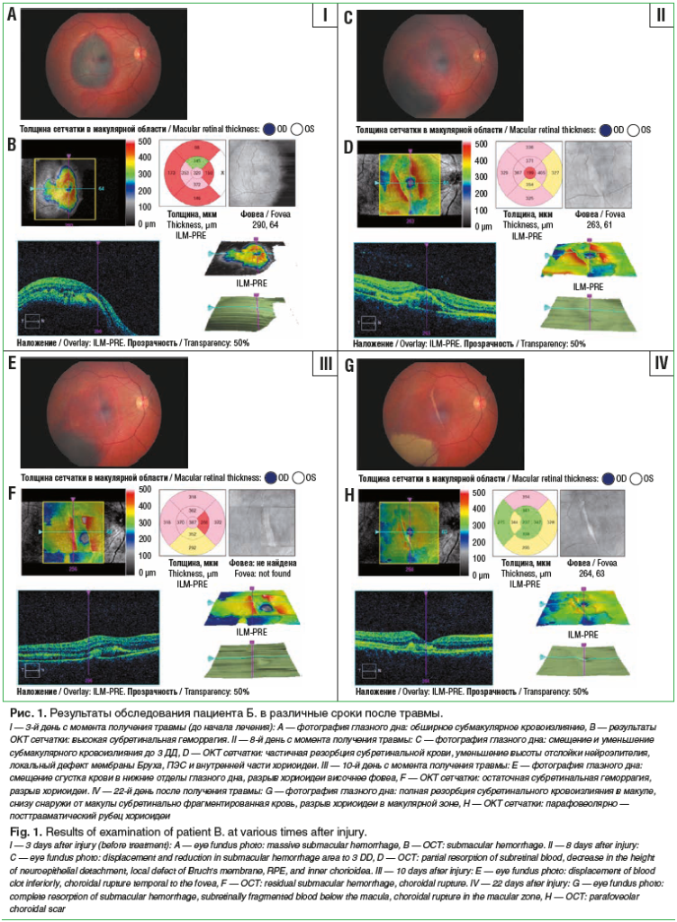 Рис. 1. Результаты обследования пациента Б. в различные сроки после травмы. I — 3-й день с момента получения травмы (до начала лечения): A — фотография глазного дна: обширное субмакулярное кровоизлияние, B — результаты ОКТ сетчатки: высокая субретинальная