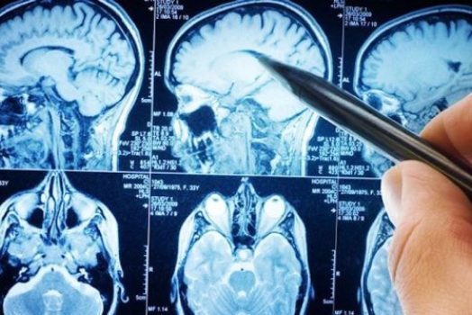 В России создали краситель для визуализации опухоли головного мозга при