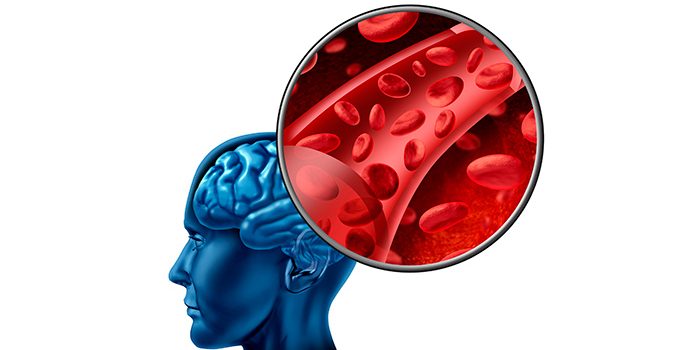 Крошечные закупорки в мозговой системе могут вызывать мигрень