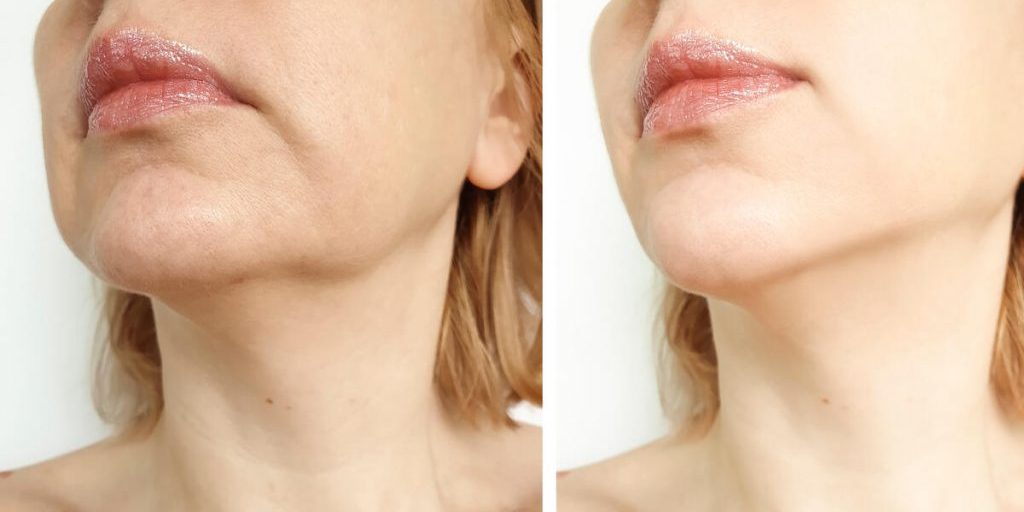 Что такое мьюинг? Как правильно делать упражнения для коррекции зубов