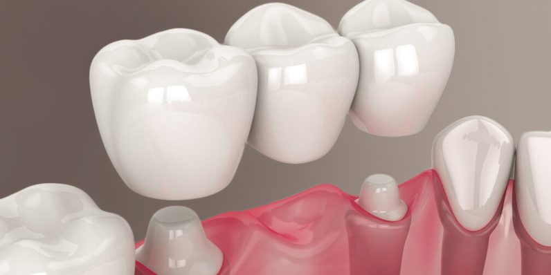 Восстанавливаем улыбку: имплантация или мост — как выбрать идеальное решение