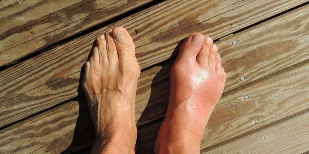 «Гипотиреоз и цирроз печени»: врач Хасиева назвала вызывающие сильные отеки