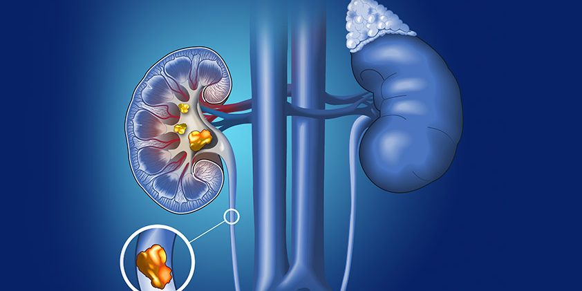 Как простая привычка связана с камнями в почках