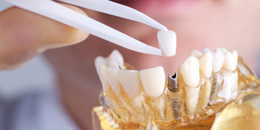 Боль, время и деньги: 7 популярных мифов об имплантации зубов