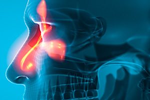 Применение тезепелумаба приводит к уменьшению размера полипов носа и заложенности носа