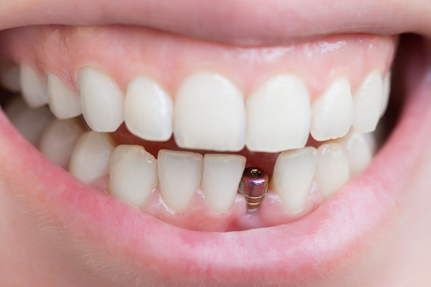 Зачем нужна имплантация зубов — Медицина 2.0