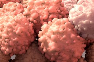 Подтверждена эффективность капивасертиба при метастатическом гормоночувствительном раке предстательной железы с дефицитом PTEN