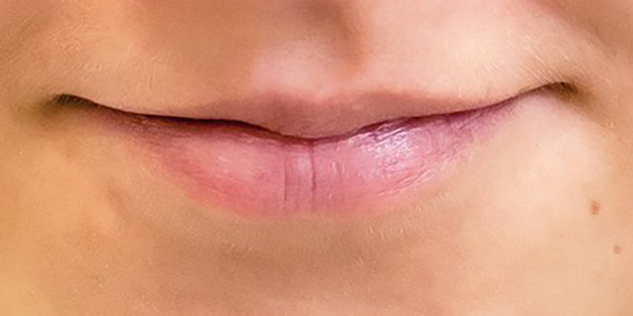 Чем опасно увеличение губ — Медицина 2.0