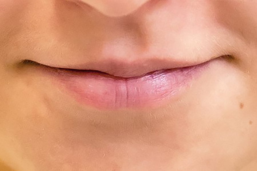 Чем опасно увеличение губ — Медицина 2.0