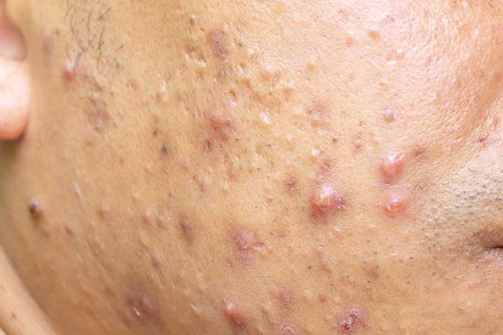 MBE: кожные клещи не вызывают прыщи, а наоборот очищают кожу