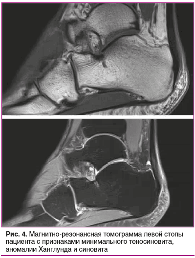 Рис. 4. Магнитно-резонансная томограмма левой стопы пациента с признаками минимального теносиновита, аномалии Ханглунда и синовита