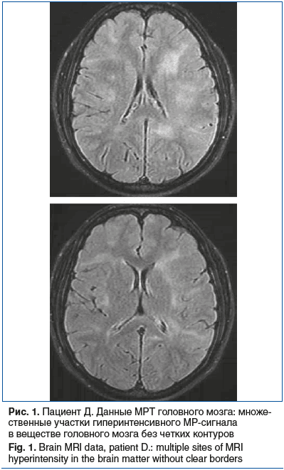 Рис. 1. Пациент Д. Данные МРТ головного мозга: множе- ственные участки гиперинтенсивного МР-сигнала в веществе головного мозга без четких контуров Fig. 1. Brain MRI data, patient D.: multiple sites of MRI hyperintensity in the brain matter without clear b