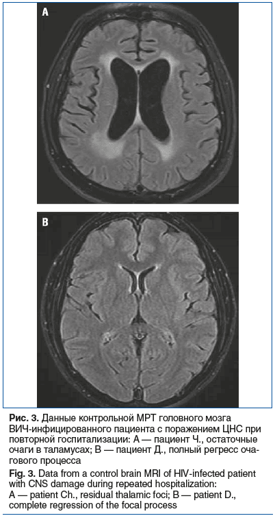 Рис. 3. Данные контрольной МРТ головного мозга ВИЧ-инфицированного пациента с поражением ЦНС при повторной госпитализации: А — пациент Ч., остаточные очаги в таламусах; B — пациент Д., полный регресс оча- гового процесса Fig. 3. Data from a control brain 