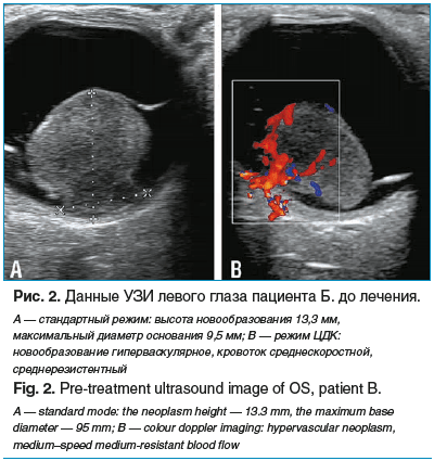 Рис. 2. Данные УЗИ левого глаза пациента Б. до лечения. А — стандартный режим: высота новообразования 13,3 мм, максимальный диаметр основания 9,5 мм; B — режим ЦДК: новообразование гиперваскулярное, кровоток среднескоростной, среднерезистентный Fig. 2. Pr