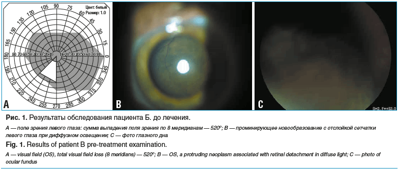 Рис. 1. Результаты обследования пациента Б. до лечения. А — поле зрения левого глаза: сумма выпадения поля зрения по 8 меридианам — 520°; B — проминирующее новообразование с отслойкой сетчатки левого глаза при диффузном освещении; C — фото глазного дна Fi