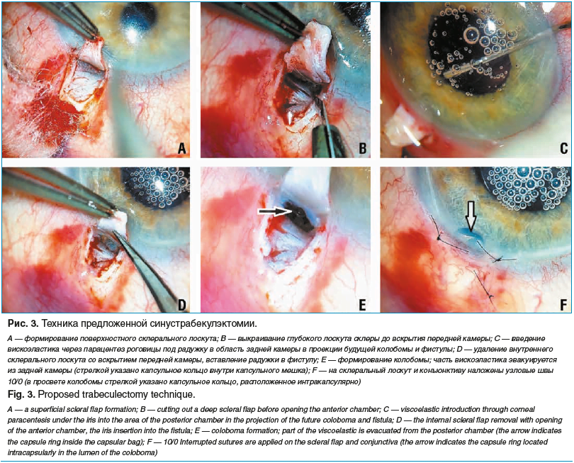 Рис. 3. Техника предложенной синустрабекулэктомии. А — формирование поверхностного склерального лоскута; В — выкраивание глубокого лоскута склеры до вскрытия передней камеры; С — введение вискоэластика через парацентез роговицы под радужку в область задне