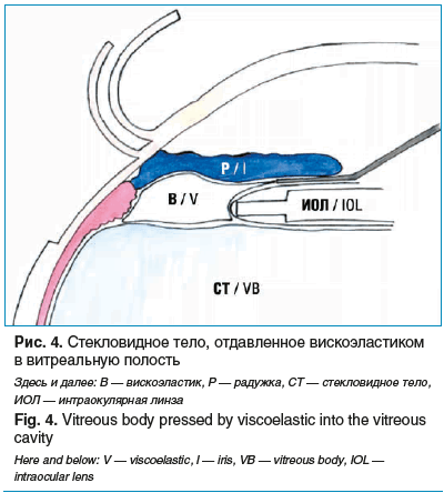 Рис. 4. Стекловидное тело, отдавленное вискоэластиком в витреальную полость Здесь и далее: В — вискоэластик, Р — радужка, СТ — стекловидное тело, ИОЛ — интраокулярная линза Fig. 4. Vitreous body pressed by viscoelastic into the vitreous cavity Here and be