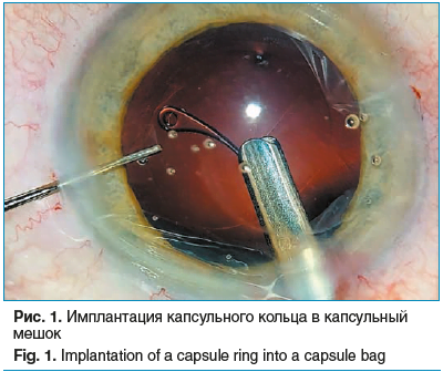 Рис. 1. Имплантация капсульного кольца в капсульный мешок Fig. 1. Implantation of a capsule ring into a capsule bag