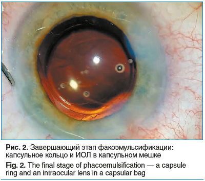 Рис. 2. Завершающий этап факоэмульсификации: капсульное кольцо и ИОЛ в капсульном мешке Fig. 2. The final stage of phacoemulsification — a capsule ring and an intraocular lens in a capsular bag