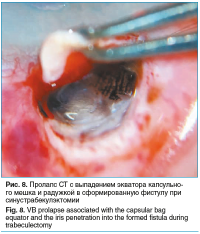 Рис. 8. Пролапс СТ с выпадением экватора капсульно- го мешка и радужкой в сформированную фистулу при синустрабекулэктомии Fig. 8. VB prolapse associated with the capsular bag equator and the iris penetration into the formed fistula during trabeculectomy