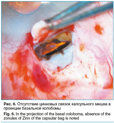 Рис. 6. Отсутствие цинновых связок капсульного мешка в проекции базальной колобомы Fig. 6. In the projection of the basal coloboma, absence of the zonules of Zinn of the capsular bag is noted