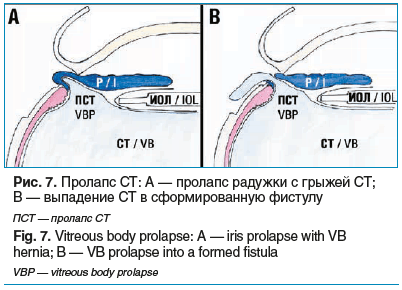 Рис. 7. Пролапс СТ: А — пролапс радужки с грыжей СТ; В — выпадение СТ в сформированную фистулу ПСТ — пролапс СТ Fig. 7. Vitreous body prolapse: A — iris prolapse with VB hernia; B — VB prolapse into a formed fistula VBP — vitreous body prolapse
