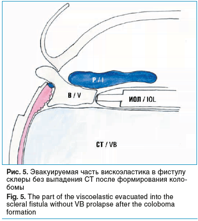 Рис. 5. Эвакуируемая часть вискоэластика в фистулу склеры без выпадения СТ после формирования коло- бомы Fig. 5. The part of the viscoelastic evacuated into the scleral fistula without VB prolapse after the coloboma formation