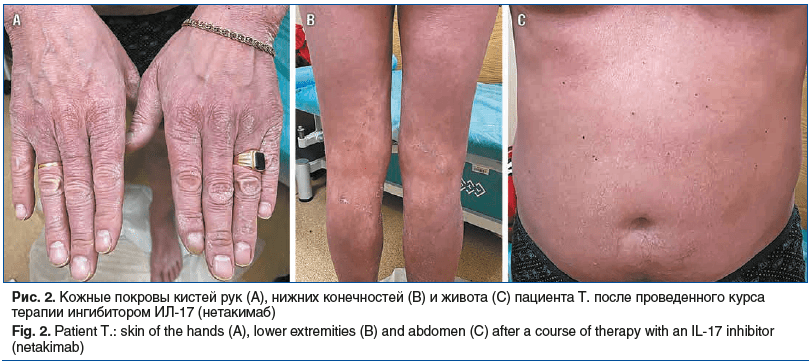 Рис. 2. Кожные покровы кистей рук (А), нижних конечностей (В) и живота (С) пациента Т. после проведенного курса терапии ингибитором ИЛ-17 (нетакимаб) Fig. 2. Patient T.: skin of the hands (A), lower extremities (B) and abdomen (C) after a course of therap