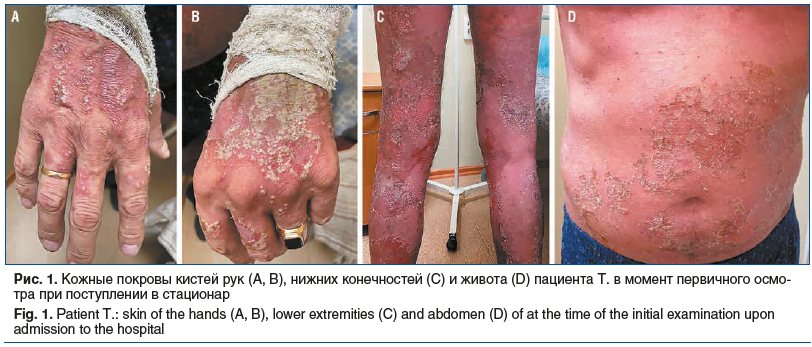 Рис. 1. Кожные покровы кистей рук (А, В), нижних конечностей (С) и живота (D) пациента Т. в момент первичного осмо- тра при поступлении в стационар Fig. 1. Patient T.: skin of the hands (A, B), lower extremities (C) and abdomen (D) of at the time of the i