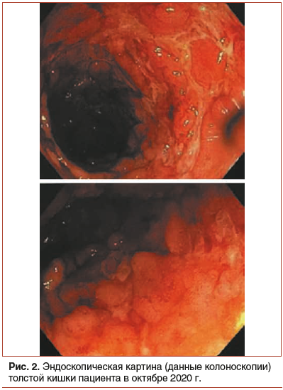 Рис. 2. Эндоскопическая картина (данные колоноскопии) толстой кишки пациента в октябре 2020 г.